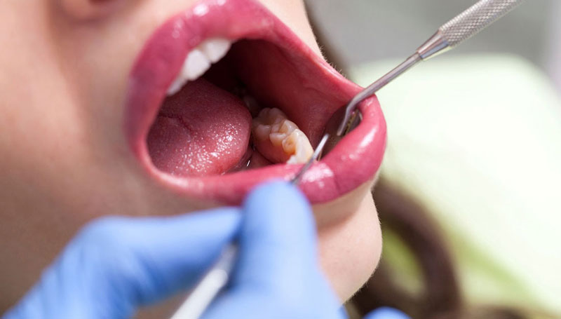 جراحی دندان عقل در کرج